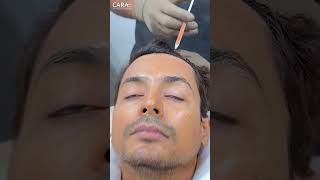 Trichometric PRP Hair Treatment to Deal With Hair Loss [upl. by Ahsekad]