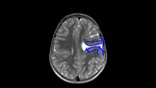 Bilateral schizencephaly  open and closed lip [upl. by Seavey]