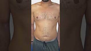 Type 4 Gynecomastia Surgery by plastic surgeon  before and after [upl. by Nosimaj]