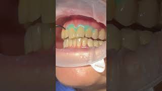 Blanqueamiento dental ANTES Y DESPUÉS 💥🦷  Clínica Dental ClearDent shortviral [upl. by Alvita686]