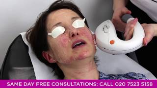 Rosacea Treatments at Pulse Light Clinic London [upl. by Reffineg41]