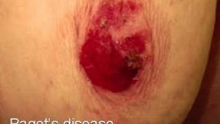 DermTV  Pagets Disease of the Breast DermTVcom 347 [upl. by Ibson]