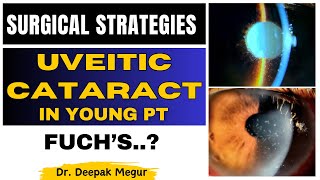 Uveitic Cataract in Young Patient Surgical strategies  Dr Deepak Megur [upl. by Irak]