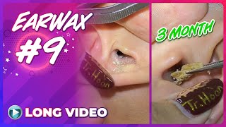 EP 9 ASMR Earwax Earwax removal is extremely cool I hope you will feel comfortable watching it [upl. by Zulema225]