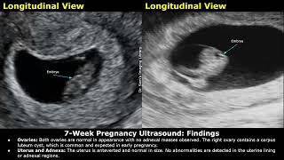 7 Week Pregnancy Obstetric Ultrasound Report Example  Normal Intrauterine Pregnancy USG Reporting [upl. by Inahs635]