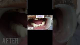 Dental Bridge bestdentalclinicdentist dentalcaredentalclinicsmilemusicshortscomedyfunny [upl. by Eiznik]