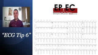 ECG Tip 6 quotIs this sinus tachycardia SVT or flutterquot [upl. by Foy630]