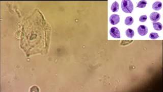 Trichomonas vaginalis الترايكوموناس فاجنالس [upl. by Ycul]