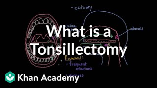 What is a tonsillectomy  Respiratory system diseases  NCLEXRN  Khan Academy [upl. by Llenrahs]