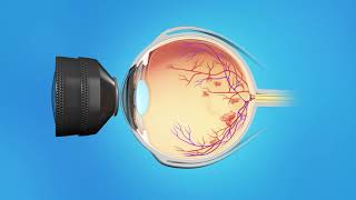 Central Retinal Vein Occlusion Treatment  Injection And Laser [upl. by Braynard]