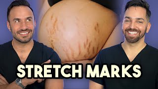 Major Announcement  How to Treat Stretch Marks like a Dermatologist [upl. by Jandy643]