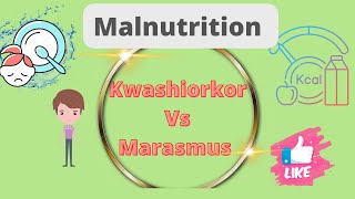 Kwashiorkor vs Marasmus DefinationDifference Malnutrition Nursing notes [upl. by Haroldson488]