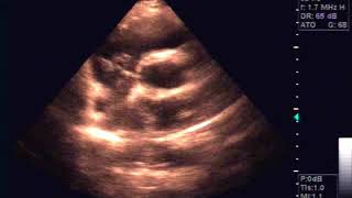 Echocardiography of Hydatide cyst in the interatrial septum [upl. by Maura]