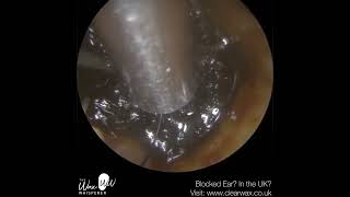 1381  Last Hope Ear Wax Removal for Patient in a lot of Discomfort [upl. by Rydder]