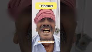 Trismus Treatment shorts trismus mouthcancer [upl. by Nura]