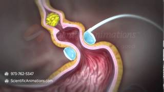 Gastric Band Animation  Digestive System Animation [upl. by Rramahs]