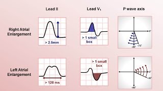 Intro to EKG Interpretation  Chamber Enlargement [upl. by Aneert]