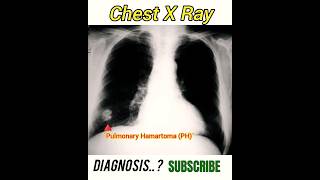 Pulmonary hamartoma PH  Diagnosis   Radiology [upl. by Ilarin238]