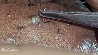 INGROWN HAIR REMOVAL 14 [upl. by Attehcnoc]