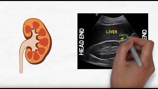 Hydronephrosis on kidney ultrasound [upl. by Eirual]