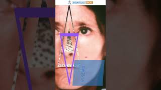 AntiSCL 70 Antibodies Their Role in Diagnosing Scleroderma [upl. by Annauqal]