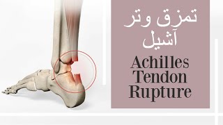 تمزق وتر آشيل  قطع وترالعرقوب Achilles tendon rupture calcaneal tendon tear [upl. by Camel]