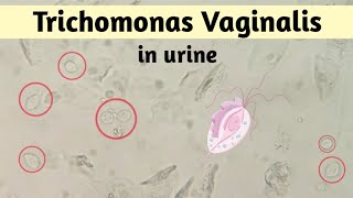 Trichomonas vaginalis in urine  ट्राइकोमोनास वेजाइनेलिस [upl. by Arahset]