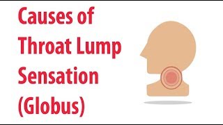 Causes of Throat Lump Sensation Globus [upl. by Nhar]