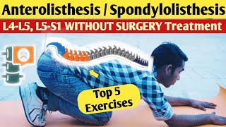 Lumbar Anterolisthesis l5 s1 treatment spondylolisthesis l4l5 exercises in hindi without surgery [upl. by Maffa]