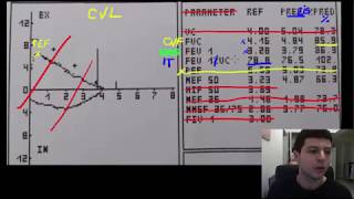 Spirometrie 2  valorile esentiale de urmarit pe o spirometrie [upl. by Hendry]