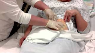 Ostomy care Healing the Skin around the Stoma [upl. by Denton]