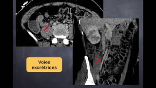 Infections urinaires  3 Pyélonéphrite aiguë  TDM [upl. by Beatty]