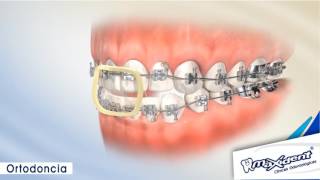 Corrección de mordida y espacios dentales quotOrtodonciaquot [upl. by Jordison]