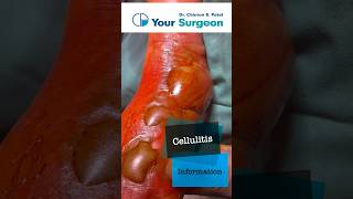 Cellulitis  Complete Information  What is Cellulitis  Treatment Options  Reasons  Debridement [upl. by Immak832]