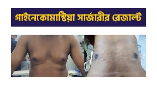 গাইনেকোমাস্টিয়া সার্জারীর রেজাল্ট। Gynecomastia Surgery Result in Bangladesh by Dr Sharif [upl. by Giselbert]