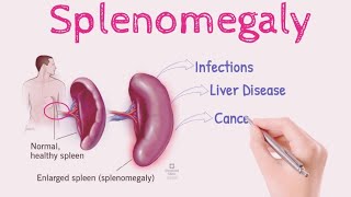 Splenomegaly OR Enlarged Spleen  Sign and Symptoms  Causes  Risk Factors  Treatment [upl. by Ariel]