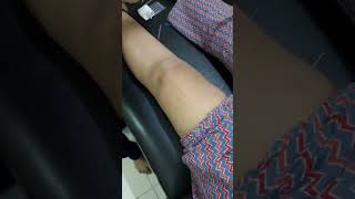 Dry Needle TherapyNeedle Therapy For knee PainReduce knee PainDrAnup [upl. by Calandra]