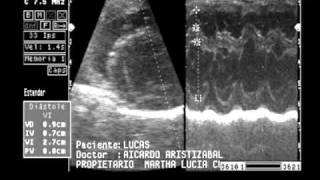 insuficiencia valvular mitral y tricuspideawmv [upl. by Davon690]