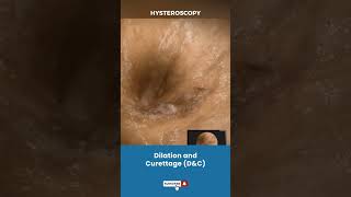 बच्चेदानी Uterus का Dilation और Curettage  Procedure for removing unwanted tissue in uterus [upl. by Nariko]