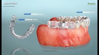 Dentium Digital Guided surgery in case of Sinus septum [upl. by Bopp]