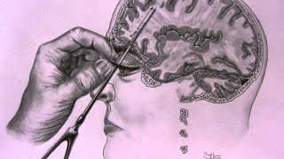 The Most TWISTED Medical Procedure in History  The Lobotomy [upl. by Daegal]