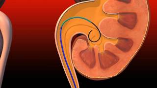 Ureteral Obstruction  Retrograde insertion of Resonance stent [upl. by Shivers]