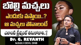 Vitiligo Symptoms Causes Treatment in Telugu  Dr Revanth About Vitiligo  SumanTv [upl. by Annwahs709]