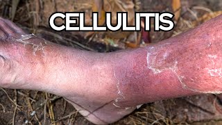 Understanding Cellulitis in Seniors Risks Complications and Prevention Strategies [upl. by Negris456]