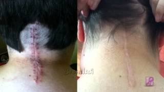 Chiari Malformation 1 Year PostOp [upl. by Latsyc685]