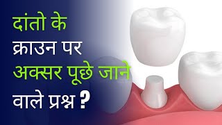 दांतो के क्राउन पर अक्सर पूछे जाने वाले प्रश्न   Faqs on Crowns [upl. by Asenad887]