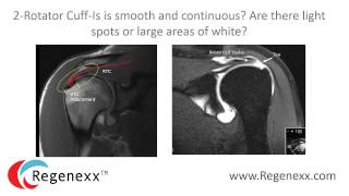 How to read your shoulder MRI with Dr Centeno of Regenexx [upl. by Appilihp]