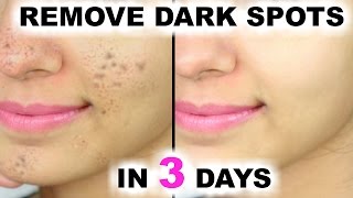 How To Cover Acne amp Scars  Sephora [upl. by Lleuqar181]