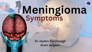 Meningioma The Brain Tumor You Might Have And Not Even Know It [upl. by Gerda569]