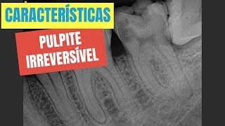 QUAIS SÃO AS CARACTERÍSTICAS DE UMA PULPITE IRREVERSÍVEL  QUICK TIP ENDOLOVERS [upl. by Gennie]